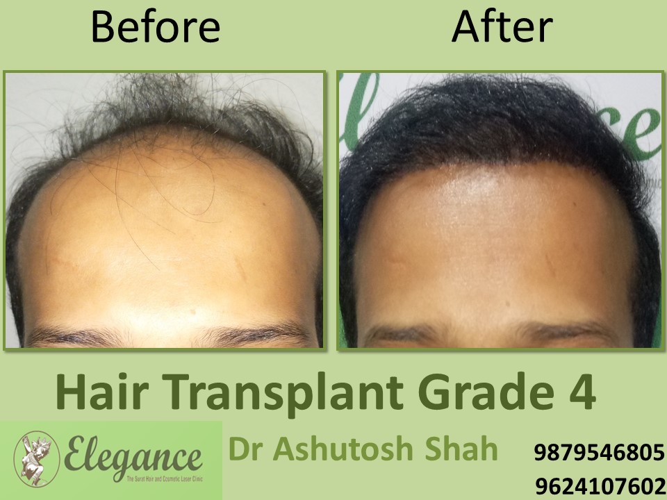 Grade 4 Hair Transplant In Bharuch, Gujarat, India