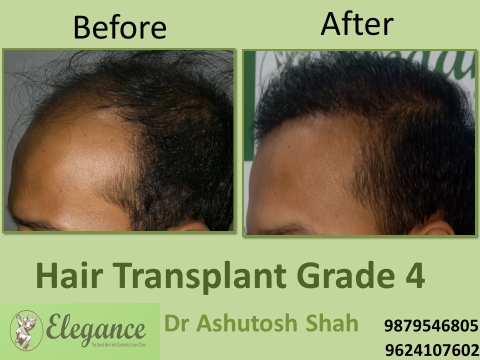 Grade 4 Hair Transplant In Navsari, Gujarat, India