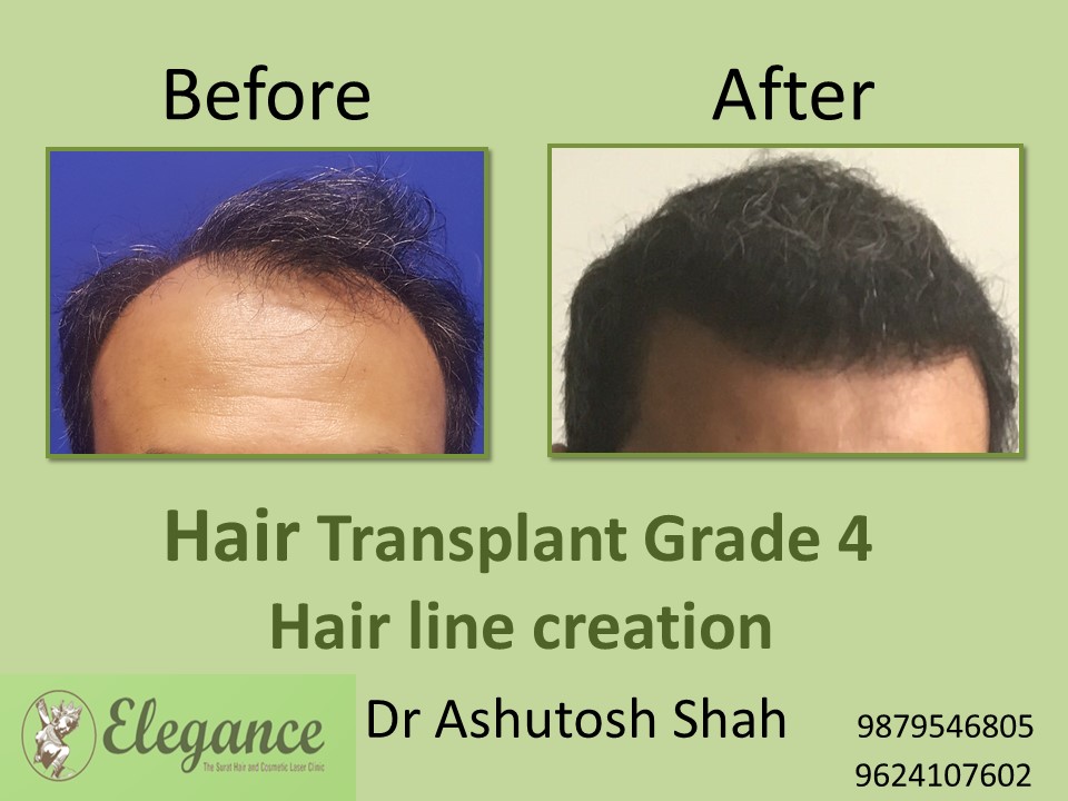 Grade 4 Hair Transplant In Visakhapatnam, Andhra Pradesh, India