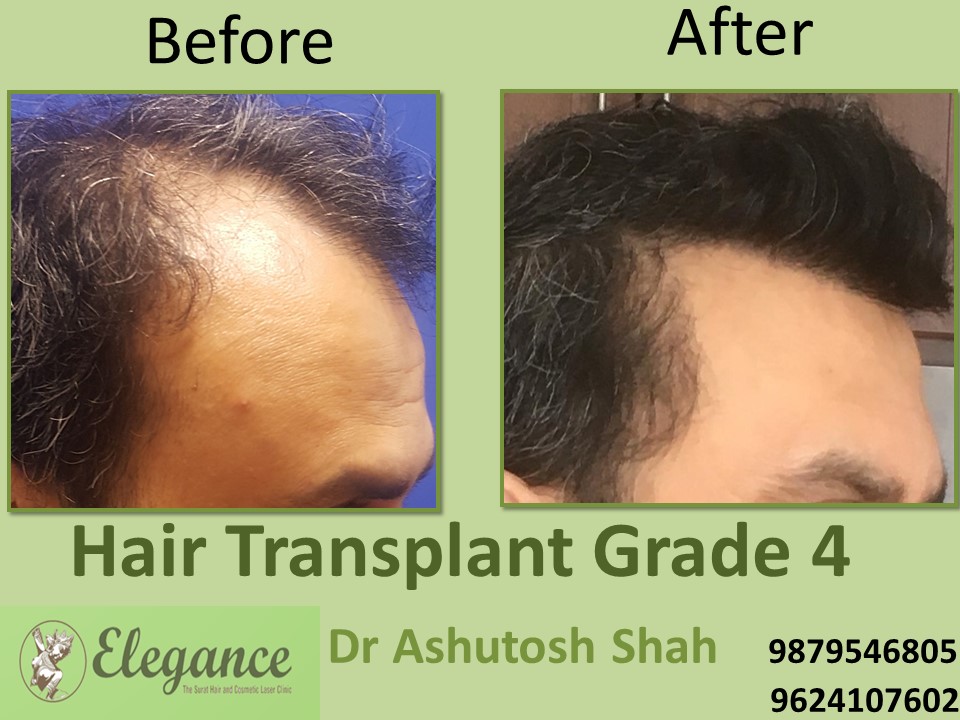 Grade 4 Hair Transplant In Pimpri-Chinchwad, Maharashtra, India