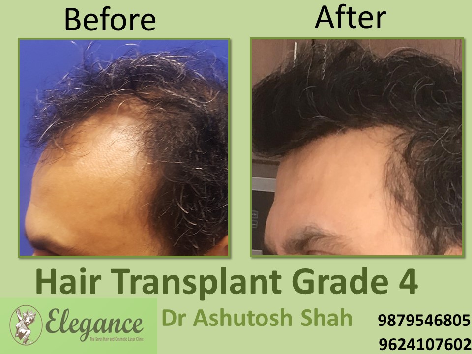 Grade 4 Hair Transplant In Patna, Bihar, India