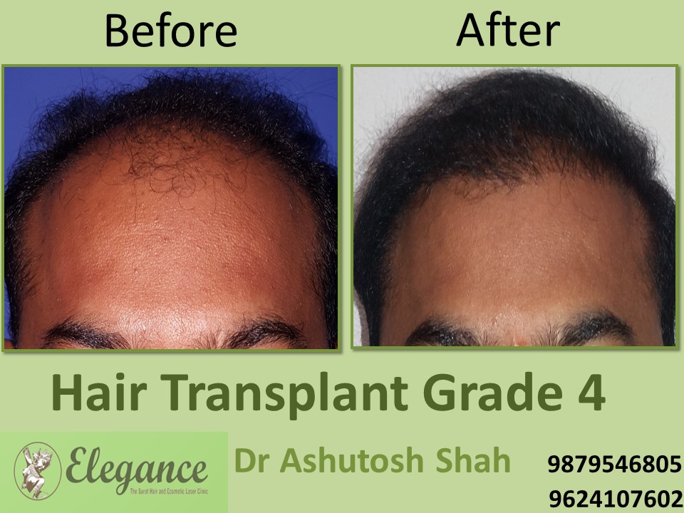 Grade 4 Hair Transplant In Ghaziabad, Uttar Pradesh, India