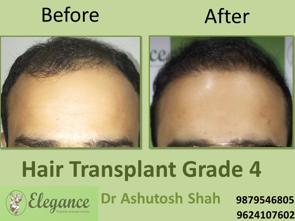 Grade 4 Hair Transplant In Ludhiana, Punjab, India