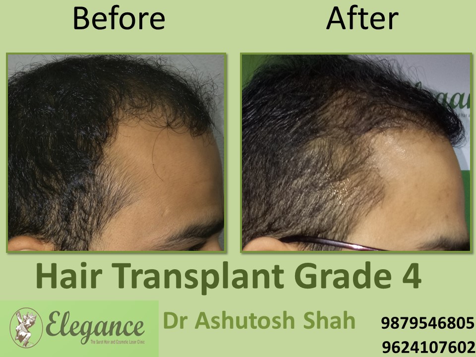 Grade 4 Hair Transplant In Agra, Uttar Pradesh, India
