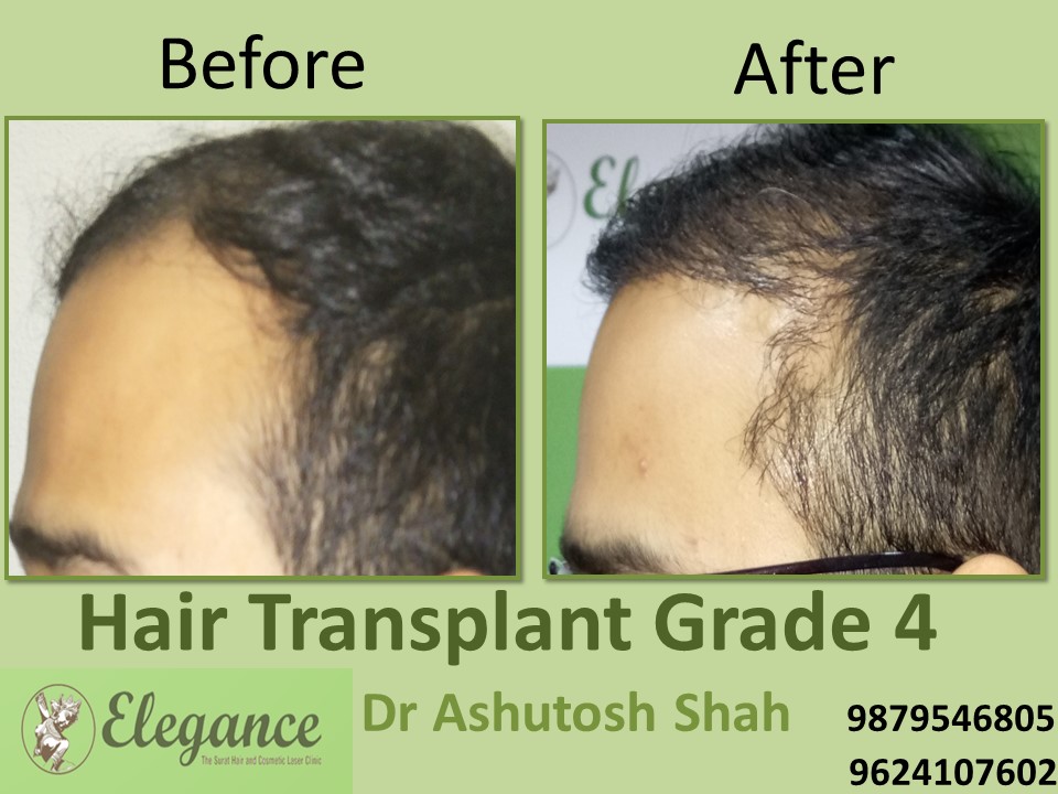Grade 4 Hair Transplant In Meerut, Uttar Pradesh, India