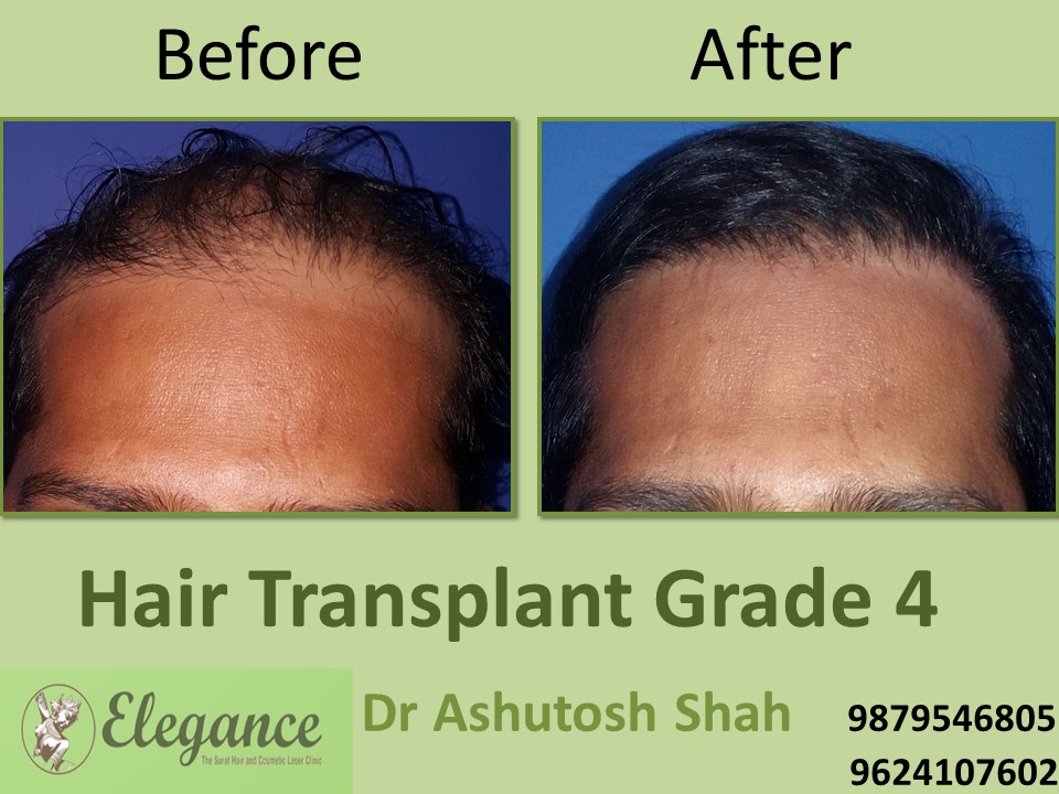 Grade 4 Hair Transplant In Varanasi, Uttar Pradesh, India