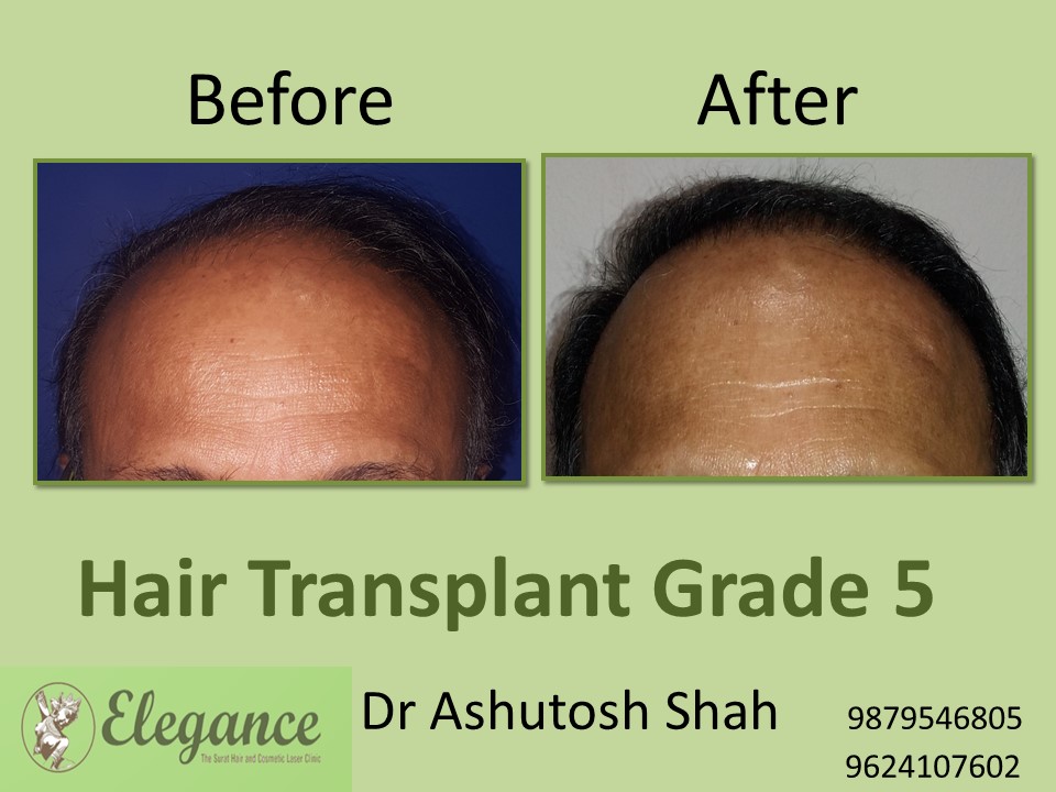 Grade 5 Hair Transplant In Amritsar, Punjab, India