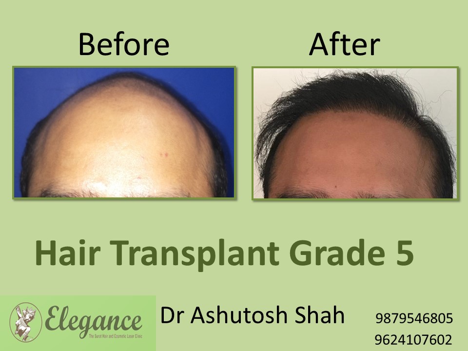 Grade 5 Hair Transplant In Navi Mumbai, Maharashtra, India