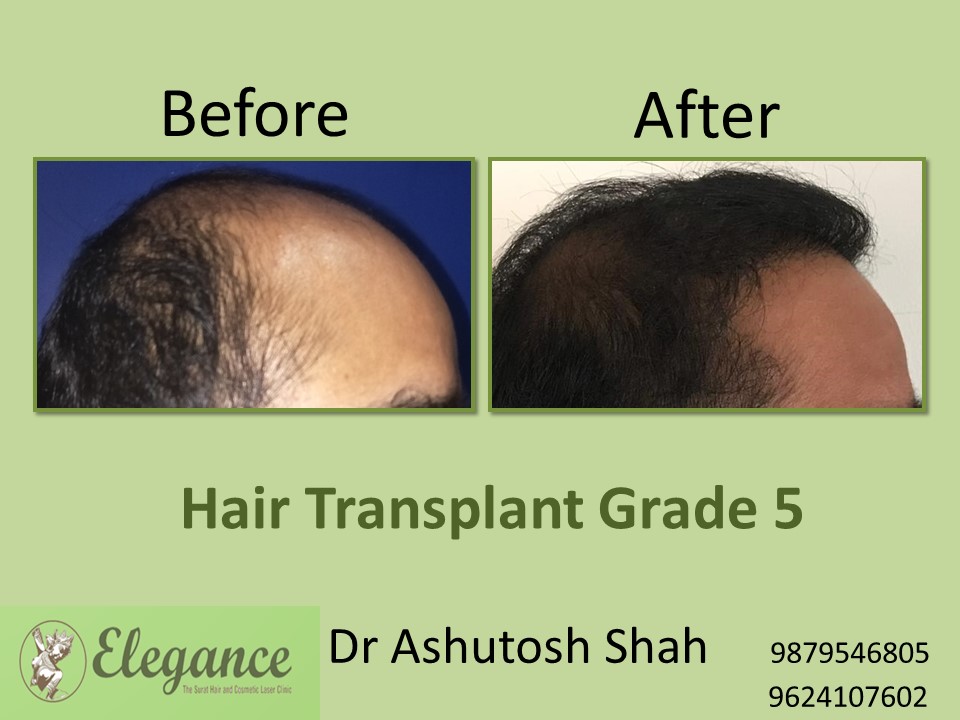 Grade 5 Hair Transplant In Allahabad, Uttar Pradesh, India