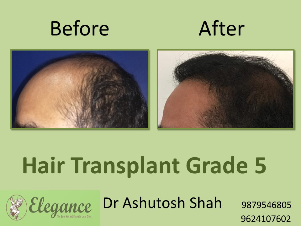 Grade 5 Hair Transplant In Howrah, West Bengal, India