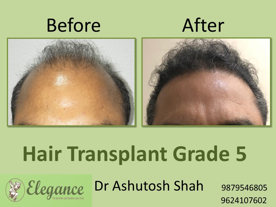 Grade 5 Hair Transplant In Gwalior, Madhya Pradesh, India
