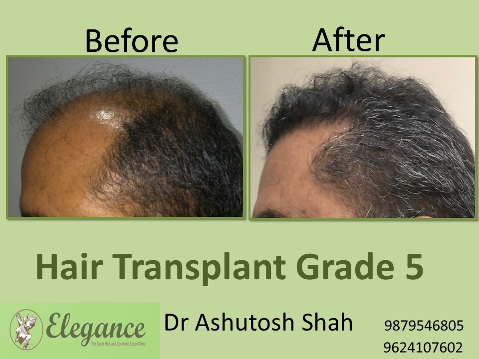 Grade 5 Hair Transplant In Jabalpur, Madhya Pradesh, India