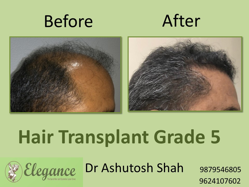 Grade 5 Hair Transplant In Coimbatore, Tamil Nadu, India