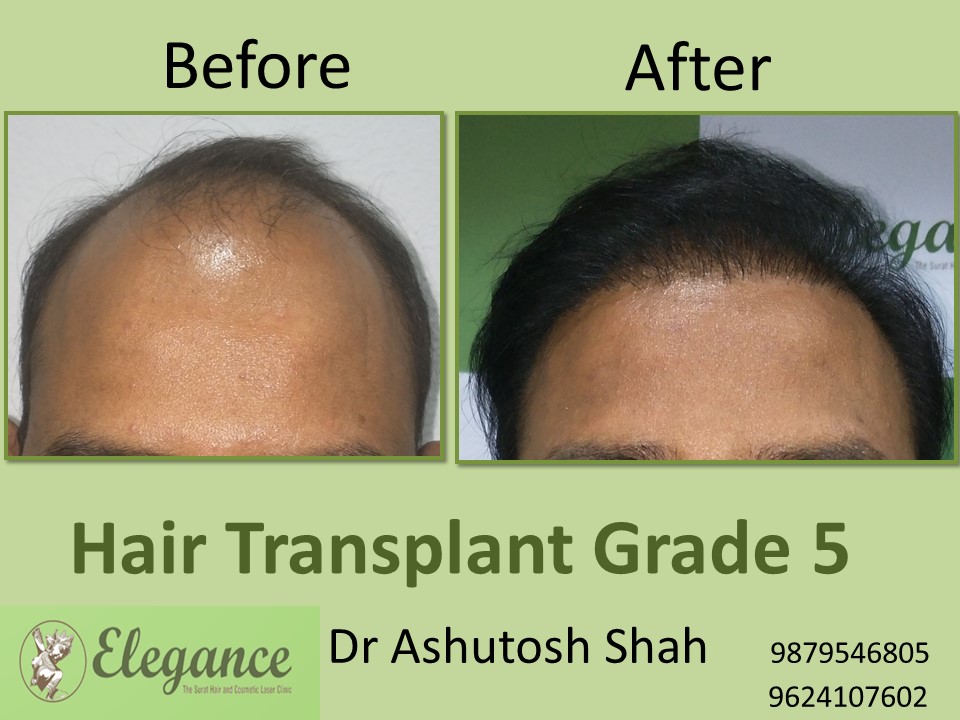 Grade 5 Hair Transplant In Vijayawada, Andhra Pradesh, India