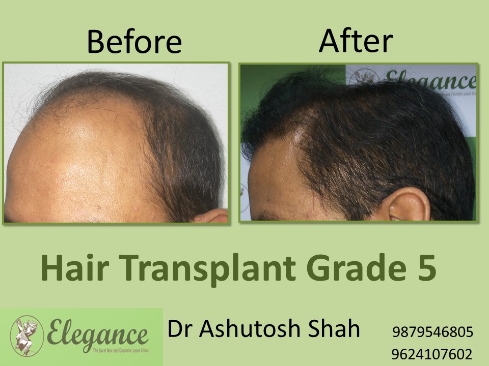 Grade 5 Hair Transplant In Jodhpur, Rajasthan, India