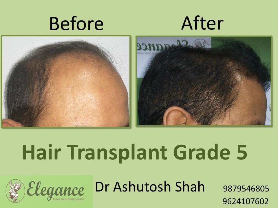 Grade 5 Hair Transplant In Madurai, Tamil Nadu, India