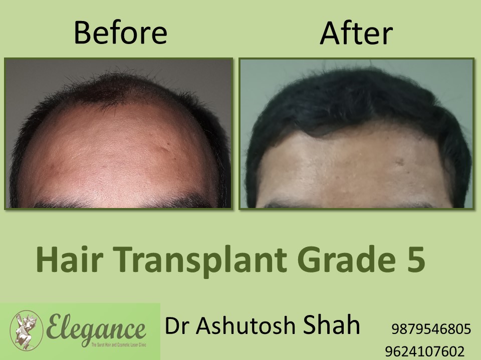 Grade 5 Hair Transplant In Raipur, Chhattisgarh, India