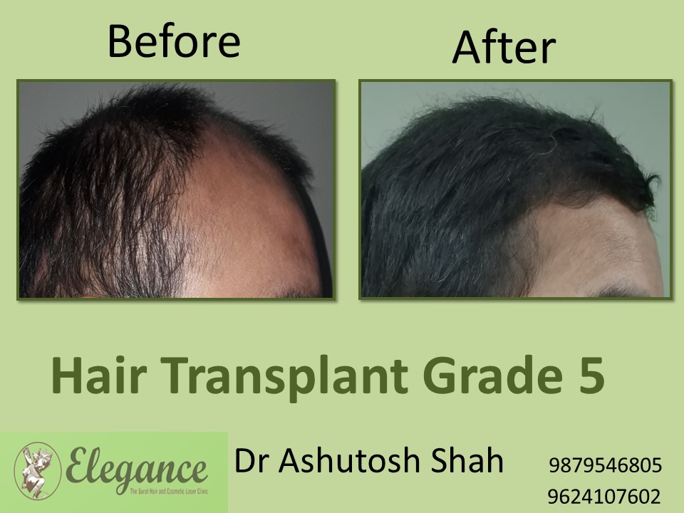 Grade 5 Hair Transplant In Kota, Rajasthan, India