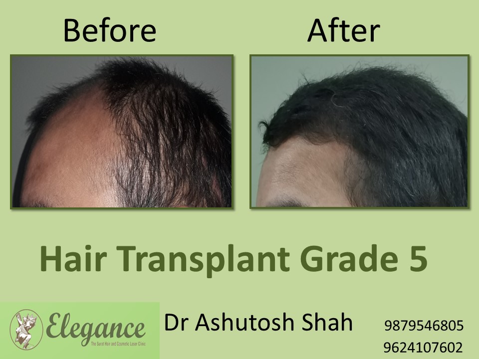 Grade 5 Hair Transplant In Chandigarh, India