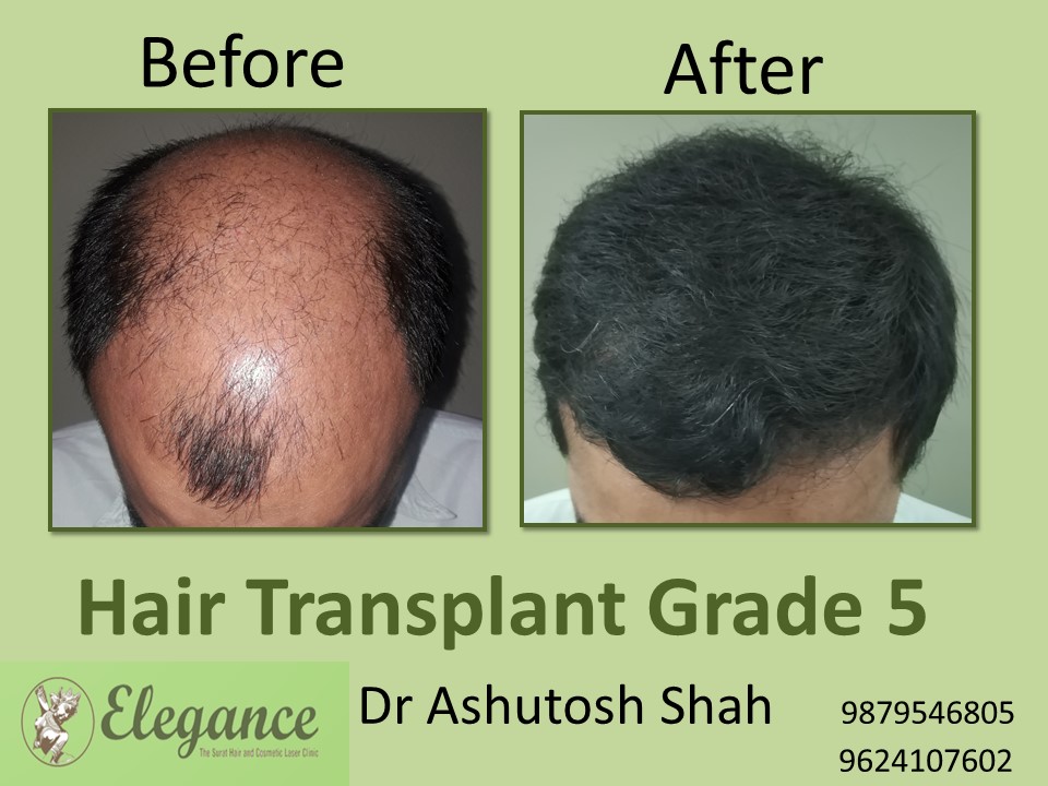 Grade 5 Hair Transplant In Guwahati, Assam, India
