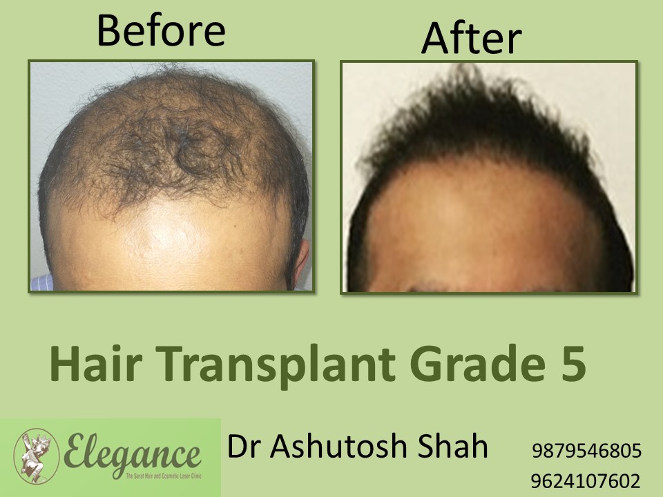 Grade 5 Hair Transplant In Solapur, Maharashtra, India