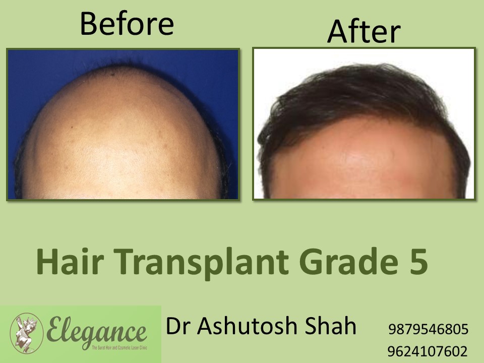 Grade 5 Hair Transplant In Hubli–Dharwad, Karnataka, India