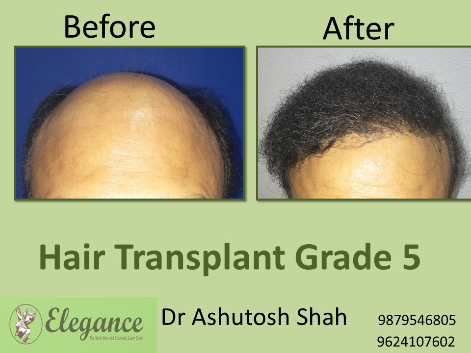 Grade 5 Hair Transplant In Mysore, Karnataka, India