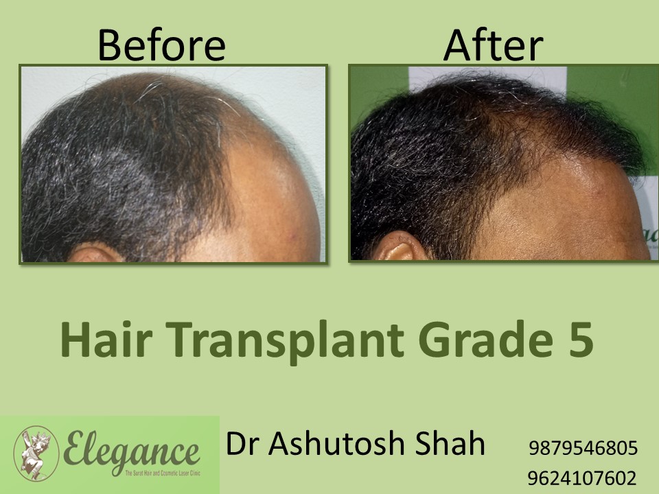 Grade 5 Hair Transplant In Tiruchirappalli, Tamil Nadu, India