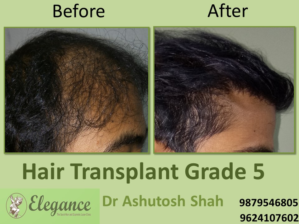 Grade 5 Hair Transplant In Surat, Gujarat, India