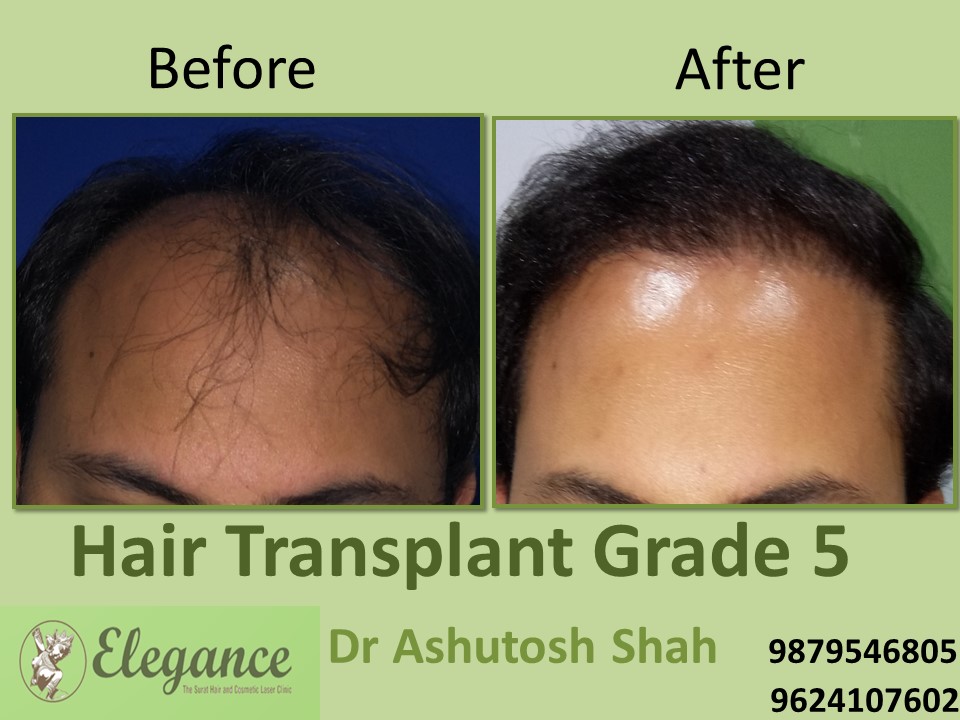 Grade 5 Hair Transplant Doctor In Surat, Gujarat, India