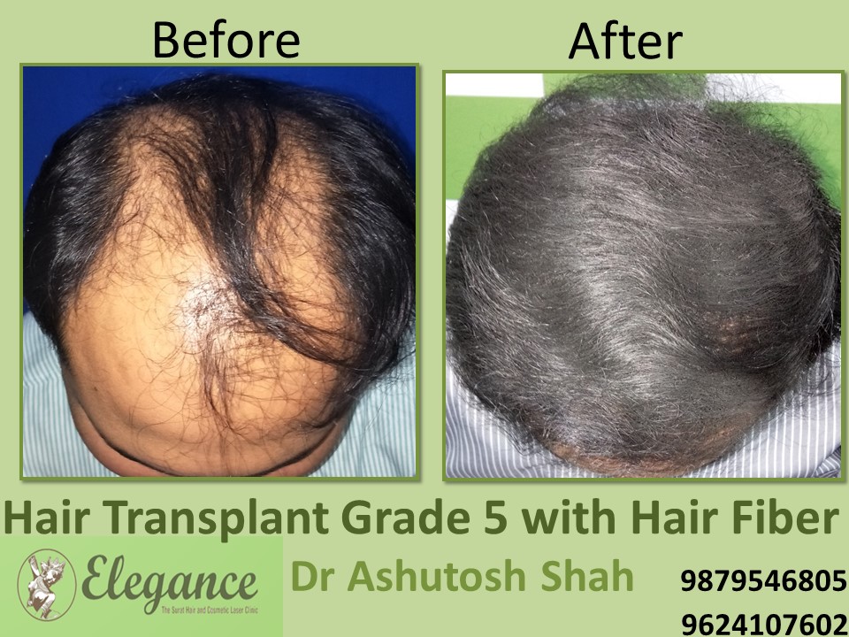 Grade 5 Hair Transplant Cost In Surat, Gujarat, India