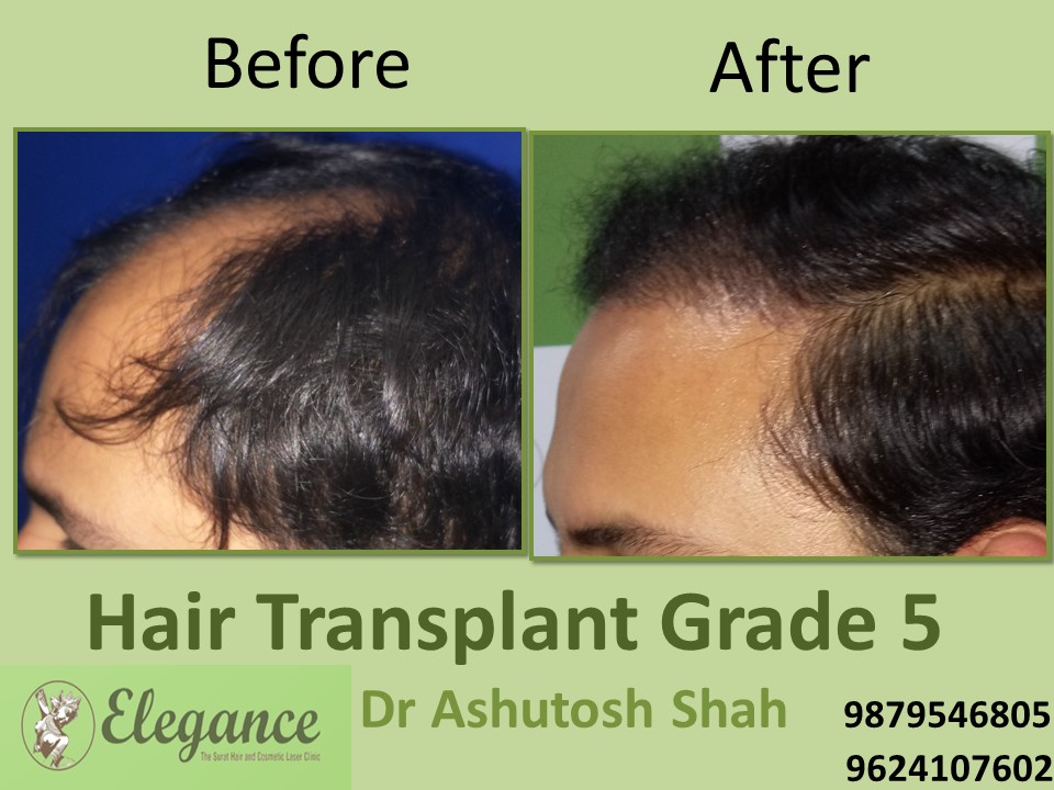 Grade 5 Hair Transplant Price In Surat, Gujarat, India
