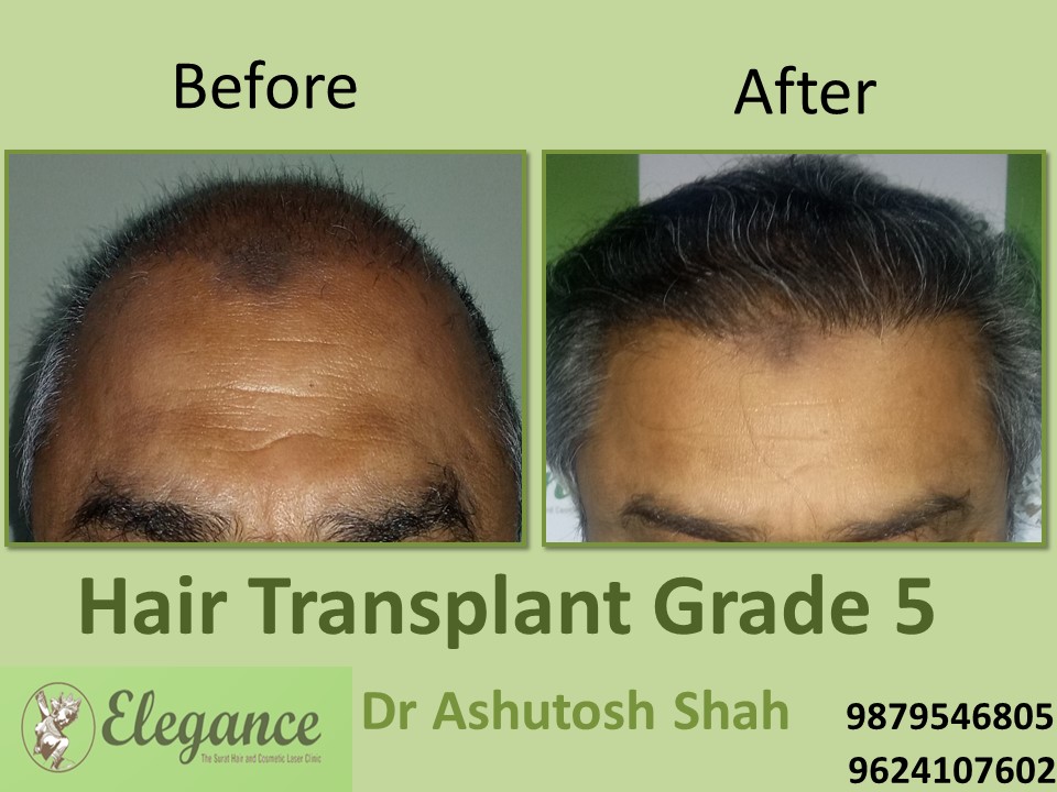 Grade 5 Hair Transplant Surgery In Surat, Gujarat, India