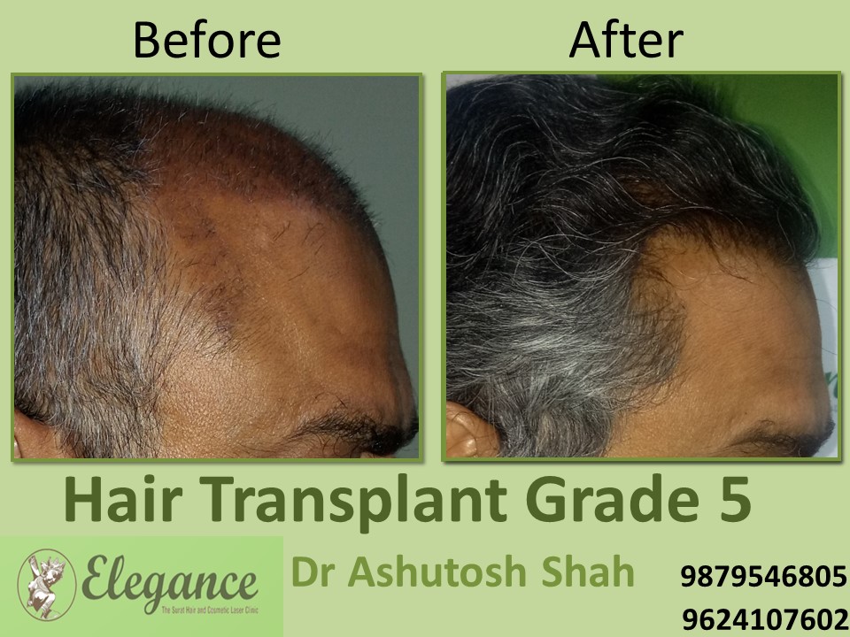 Grade 5 Hair Transplant Result In Surat, Gujarat, India