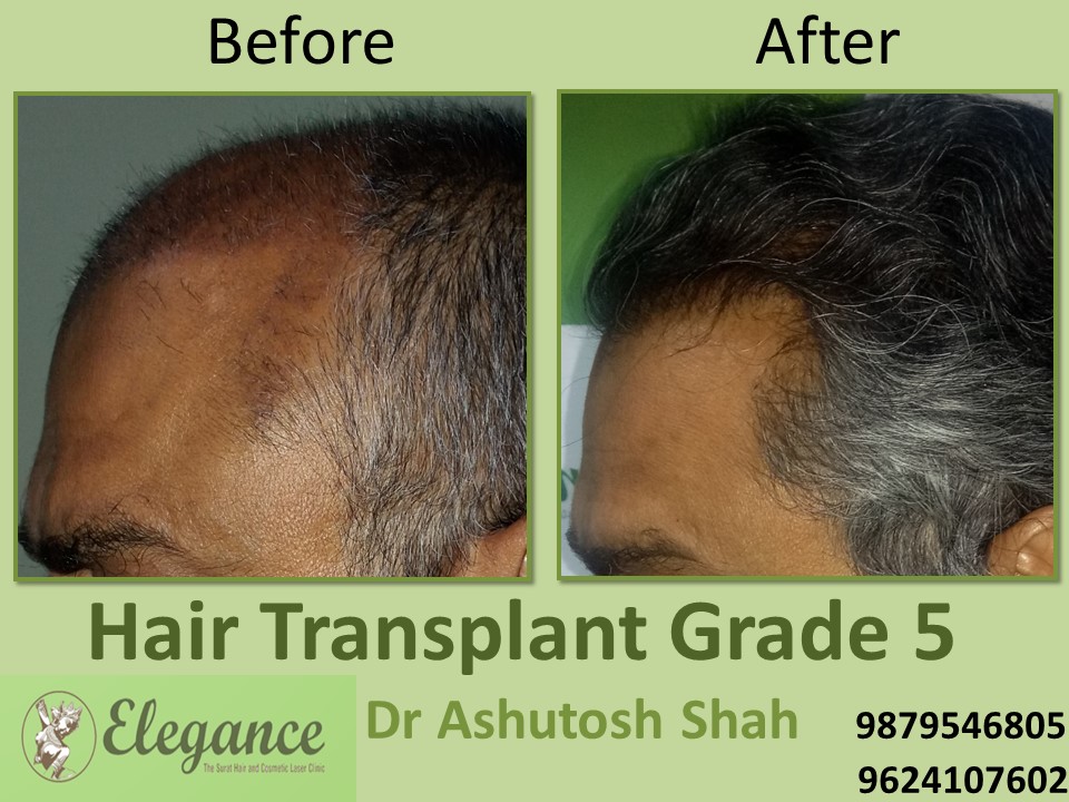 Grade 5 Hair Transplant Before And After In Surat, Gujarat, India
