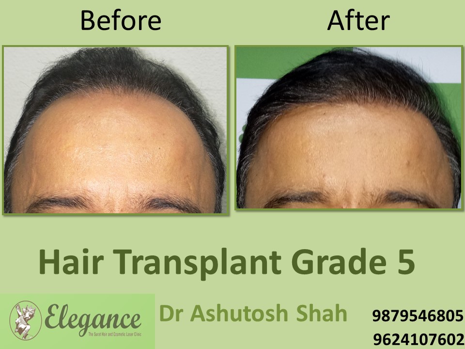 Grade 5 Hair Transplant In Vapi, Gujarat, India