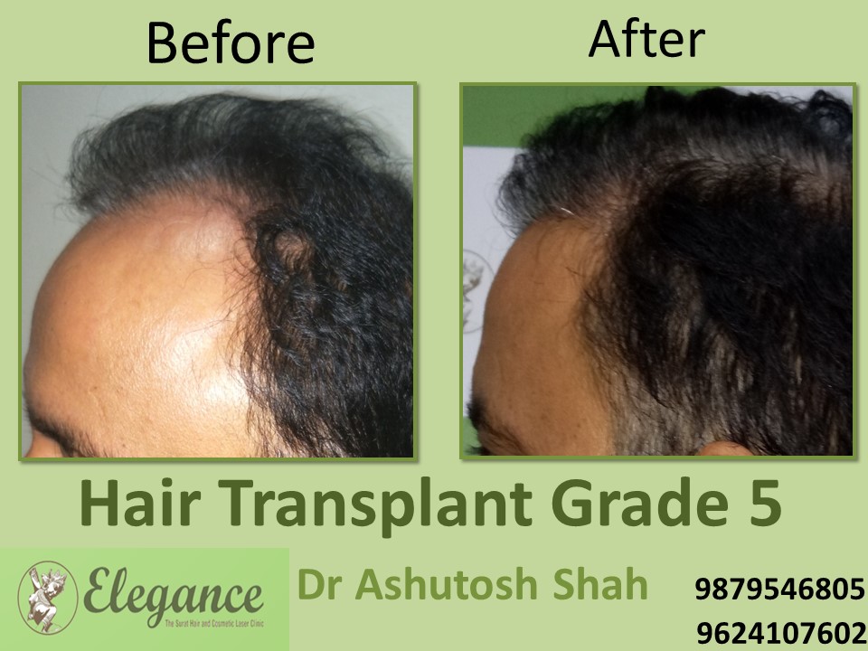Grade 5 Hair Transplant In Valsad, Gujarat, India