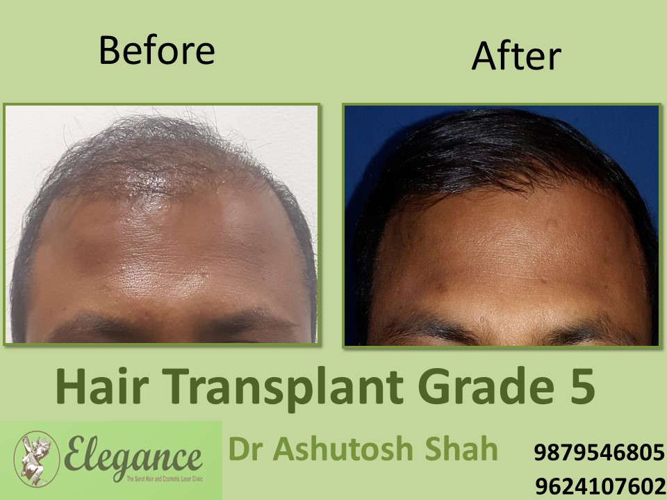 Grade 5 Hair Transplant In Rajkot, Gujarat, India