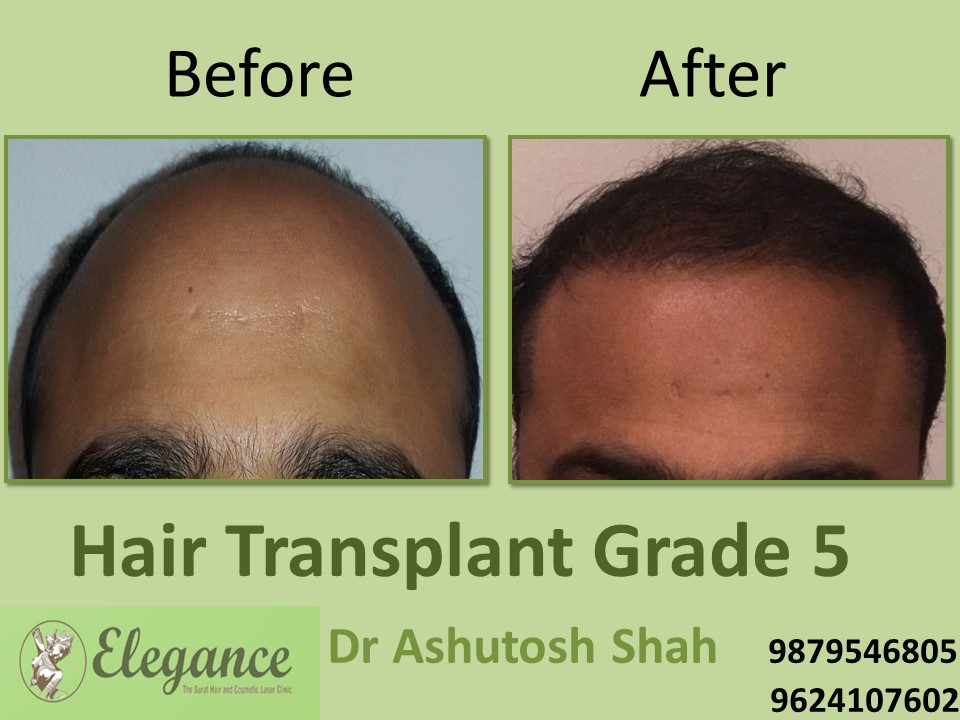 Grade 5 Hair Transplant In Bhuj, Gujarat, India