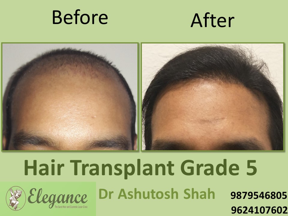 Grade 5 Hair Transplant In Nashik, Maharashtra, India