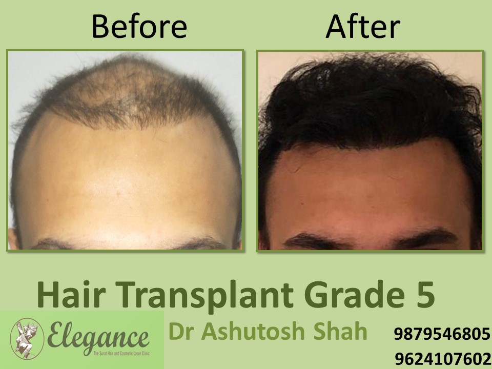 Grade 5 Hair Transplant In Ranchi, Jharkhand, India