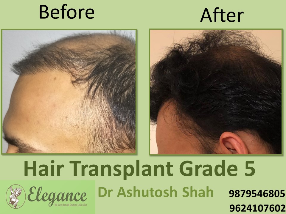 Grade 5 Hair Transplant In Faridabad, Haryana, India