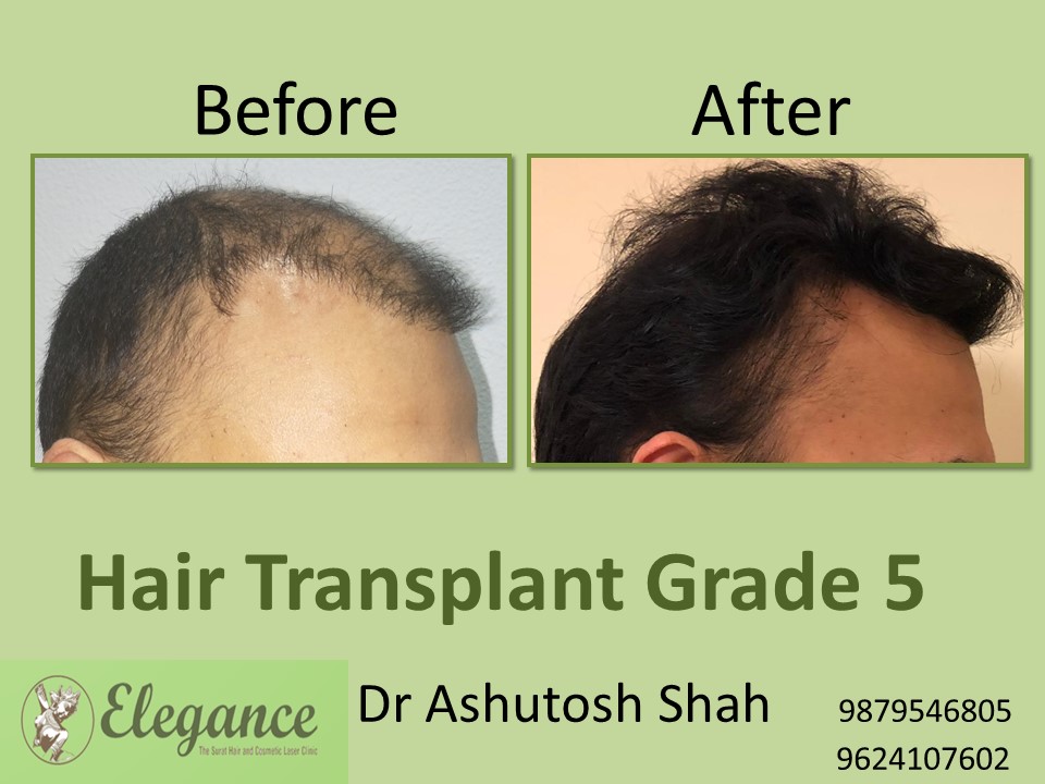 Grade 5 Hair Transplant In Meerut, Uttar Pradesh, India