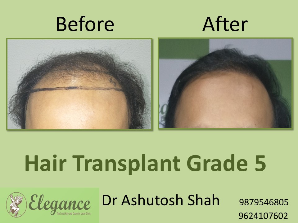 Grade 5 Hair Transplant In Kalyan-Dombivli, Maharashtra, India