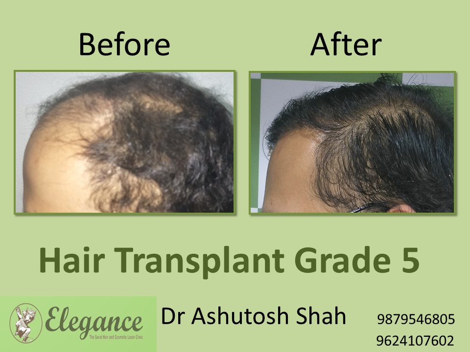 Grade 5 Hair Transplant In Vasai-Virar, Maharashtra, India