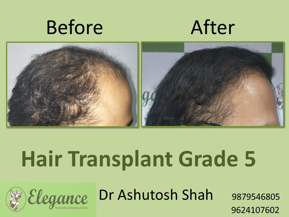 Grade 5 Hair Transplant In Varanasi, Uttar Pradesh, India