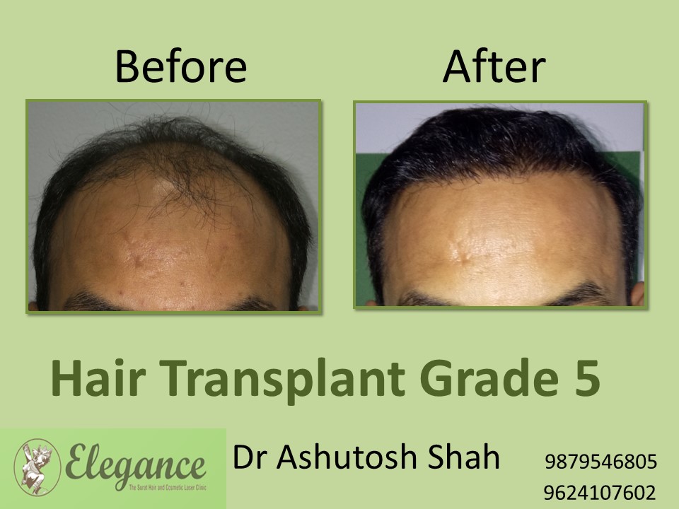 Grade 5 Hair Transplant In Srinagar, Jammu and Kashmir, India