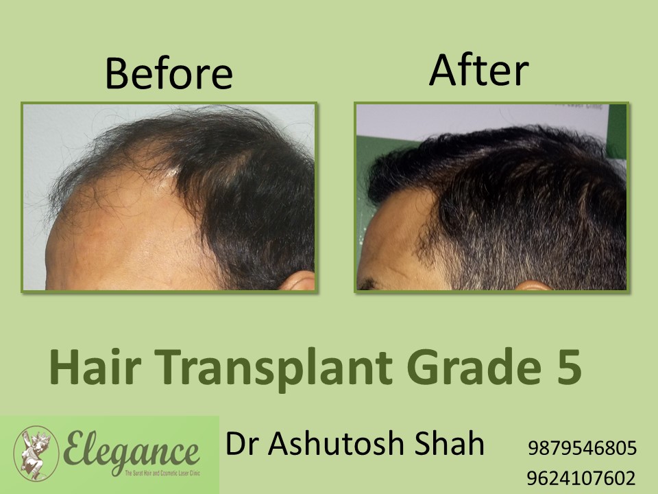 Grade 5 Hair Transplant In Aurangabad, Maharashtra, India