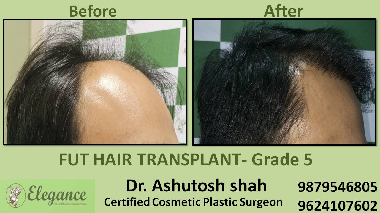 Loss Hair Treatment In Surat, Gujarat, India