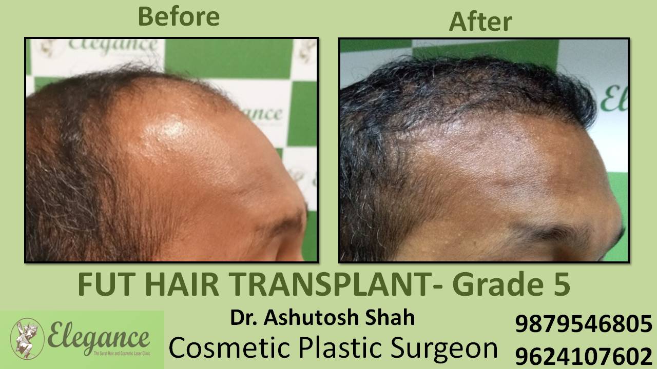 Loss Hair Treatment In Vapi, Gujarat, India